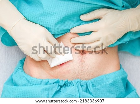 A young Caucasian male patient in medical disposable pajamas and in sterile surgical white gloves wipes with a dry cloth around the colon to replace the colon after surgery at home, flat lay close-up.