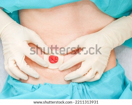 Young caucasian male patient in medical disposable pajamas and in sterile surgical white gloves applies a sticky circle to the protruding intestine on the abdomen to replace the colostomy bag 