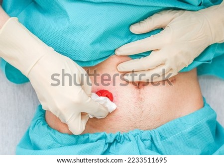 A young Caucasian male patient in medical disposable pajamas and in sterile surgical white gloves wipes with a dry cloth around the colon to replace the colon after surgery at home, flat lay Medical 