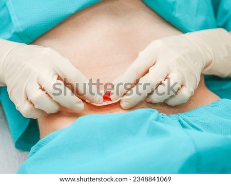 Young caucasian male patient in medical disposable pajamas and in sterile surgical white gloves takes off applies a sticky circle to the protruding intestine on the abdomen to replace the colostomy ba