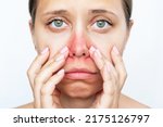 A young caucasian sad woman with a red rash near the nose touches the face with her hands isolated on white background. Worried girl sneezes from allergy 