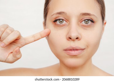 A Young Caucasian Woman Pointing Dark Circles Under The Eyes With Her Finger. Bruises Under The Eyes Are Caused By Fatigue, Nervousness, Lack Of Sleep, Insomnia And Stress. Skin Care, Cosmetology