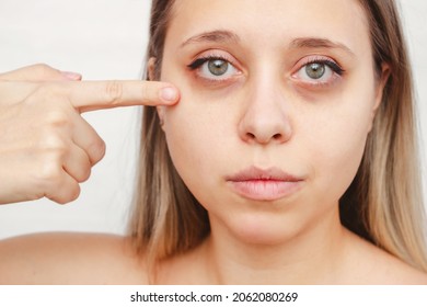 A Young Caucasian Woman Points Dark Circles Under The Eyes With Her Finger. Bruises Under The Eyes Are Caused By Fatigue, Nervousness, Lack Of Sleep, Insomnia And Stress. Skin Care, Cosmetology