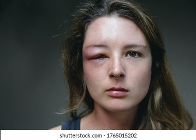 Young Caucasian Woman With A Swollen Eye From A Wasp's Sting. Allergy Reaction On Wasp Bite.