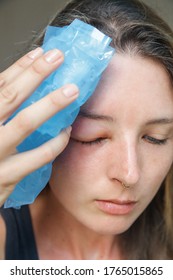 Young Caucasian Woman With A Swollen Eye From A Wasp's Sting. Allergy Reaction On Wasp Bite.