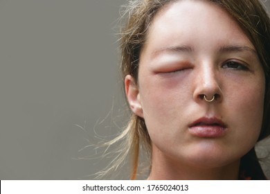 Young Caucasian Woman With A Swollen Eye From A Wasp's Sting. Allergy Reaction On Wasp Bite.