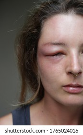 Young Caucasian Woman With A Swollen Eye From A Wasp's Sting. Allergy Reaction On Wasp Bite.