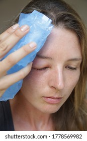 Young Caucasian Woman With A Swollen Eye From A Wasp's Sting. Allergy Reaction On Wasp Bite.	