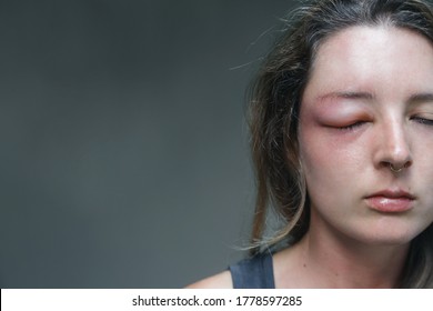 Young Caucasian Woman With A Swollen Eye From A Wasp's Sting. Allergy Reaction On Wasp Bite.	