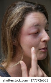 Young Caucasian Woman With A Swollen Eye From A Wasp's Sting. Allergy Reaction On Wasp Bite.