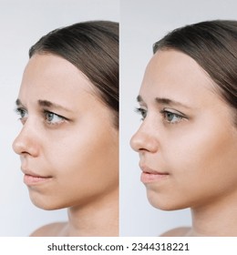 Young caucasian woman's face with drooping upper eyelid before and after blepharoplasty on a gray background. The result of plastic surgery. Changing the shape, cut of the eyes