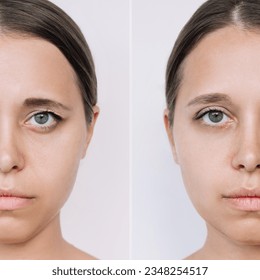 Young caucasian woman's face with drooping upper eyelid before and after blepharoplasty on a light background. Result of plastic surgery. Changing the shape, cut of the eyes. Difference, comparison