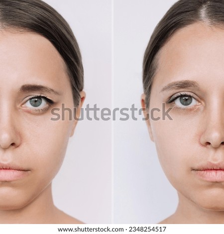 Young caucasian woman's face with drooping upper eyelid before and after blepharoplasty on a light background. Result of plastic surgery. Changing the shape, cut of the eyes. Difference, comparison