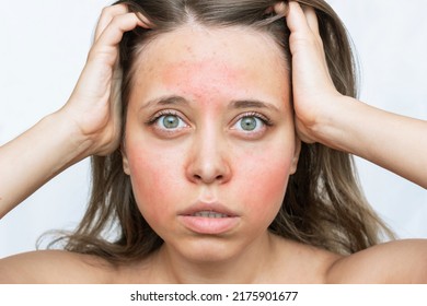 A Young Caucasian Worried Woman With A Red Allergic Rash On Her Cheeks And Forehead Isolated On White Background. Allergy On The Face. Allergic Reaction To Food, Cosmetics, Medicines 