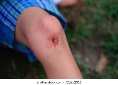 A Young Caucasion Boy Scraped His Knee. A Bit Of Blood.