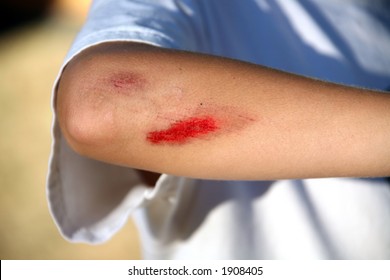 Young Child With Bloody Scrape On Arm