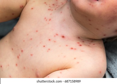 Young Child with Chickenpox