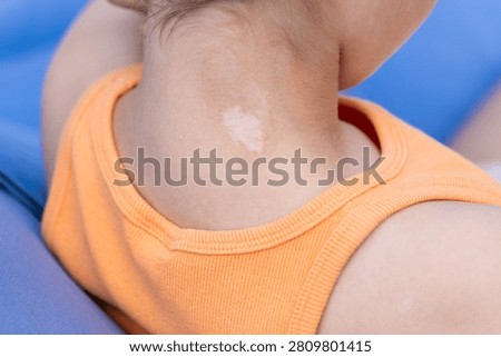 Young child with vitiligo patch on the neck wearing orange shirt
