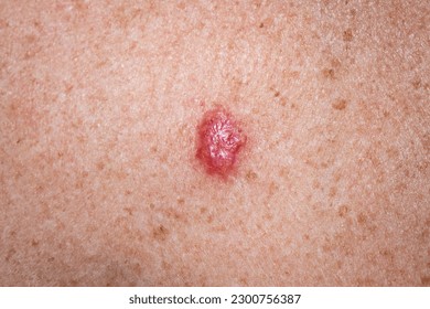 Young female 30s close up of chest prior to applying imiquimod cream medication to basal cell carcinoma.