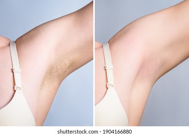Young female with armpit hair. Before and after removal hair collage. Depilation concept.