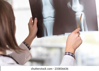 Young female doctor looking at the x-ray picture of knee injury in a hospital