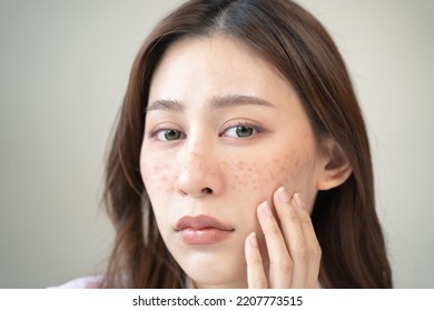 Young Female Have Freckles On Her Face.