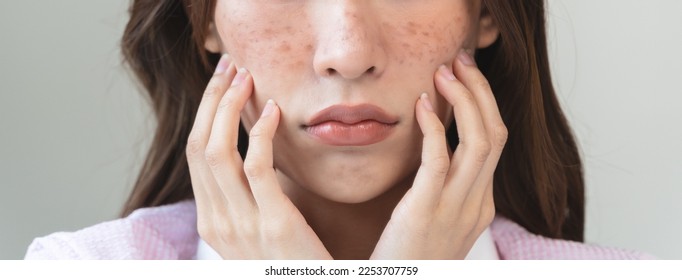 young female have freckles on her face.