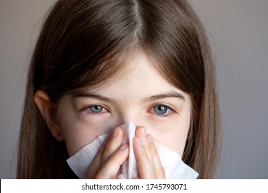 The Young Girl Is Allergic, She Blows Her Nose In A Napkin. Conjunctivitis, Lacrimation, Red Eyes