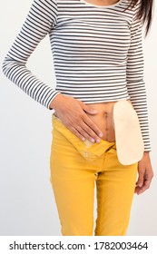 Young Girl With Colostomy Bag.