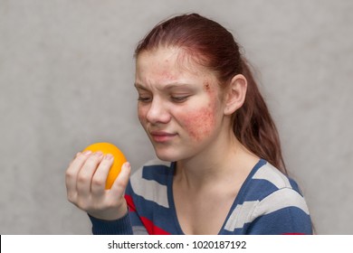 A Young Girl With A Red Rash On Her Face Holds An Orange In Her Hands. Food Allergy