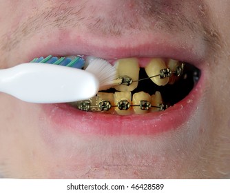 Young Gross Man Brushes His Dirty Disgusting Yellow Crooked Teeth With Braces. Closeup Image With Detail.