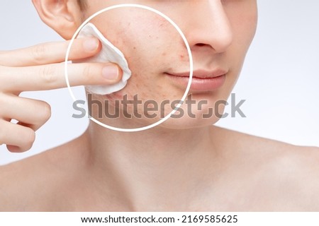 A young guy with problem skin on his face. Photos before and after acne treatment.Cleansing the skin from impurities.