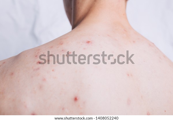 Young Guy Problem Skin On Broad Stock Photo Edit Now 1408052240