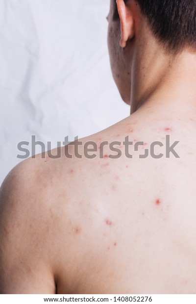 Young Guy Problem Skin On Broad Stock Photo Edit Now 1408052276