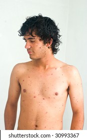 Young Male Patient With Chicken Pox