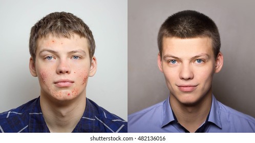 Young Man With Acne On His Face - A Problem Skin Before And After Treatment