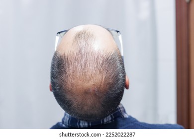 Young man with alopecia looking at his head and hair in the mirror at home