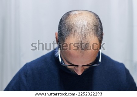 Young man with alopecia looking at his head and hair in the mirror at home