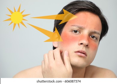 Young Man With A Bad Sunburn On His Face