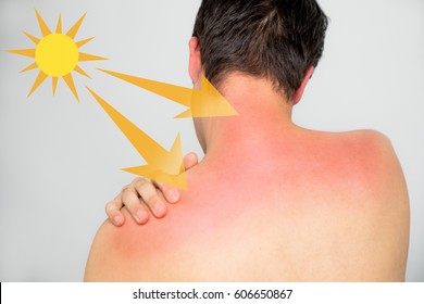 Young Man With A Bad Sunburn On His Back