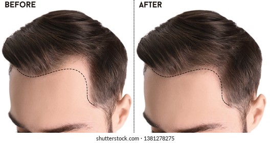 Young man before and after hair loss treatment against white background, closeup