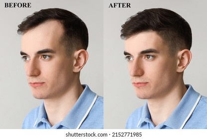 Young Man Before And After Hair Loss Treatment On Light Background