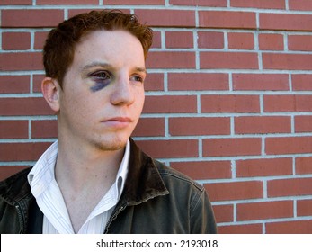 Young Man With Black Eye That Is Starting To Heal