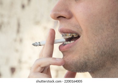 young man in braces smoking a cigarette close-up - Shutterstock ID 2200164005