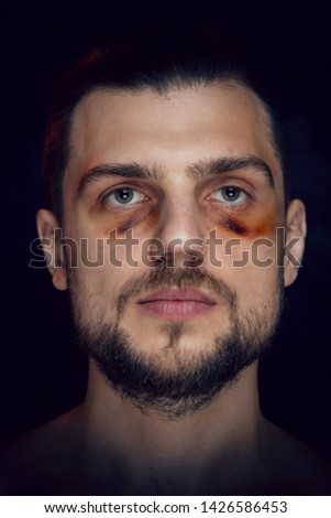Young man with bruise black eye hematoma, violence victim.