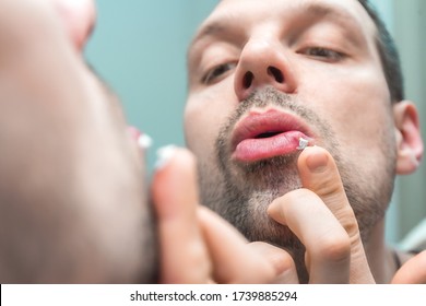 Young Man With Cold Sore Looking In Mirror At Bathroom. Reflection Of Unshaven Man In Mirror With Herpes Virus Problem On Lip. Blister Of Fever In Mouth Of Person. Suffering, Treatment With Ointment