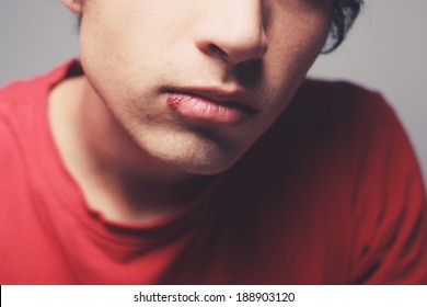 Young Man With A Cold Sore On His Lip