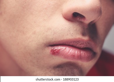 Young Man With A Cold Sore On His Lip