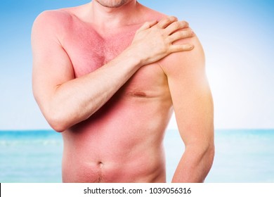 Young Man With Damaged Skin From The Sun, Sunburn