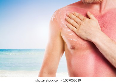 Young Man With Damaged Skin From The Sun, Sunburn